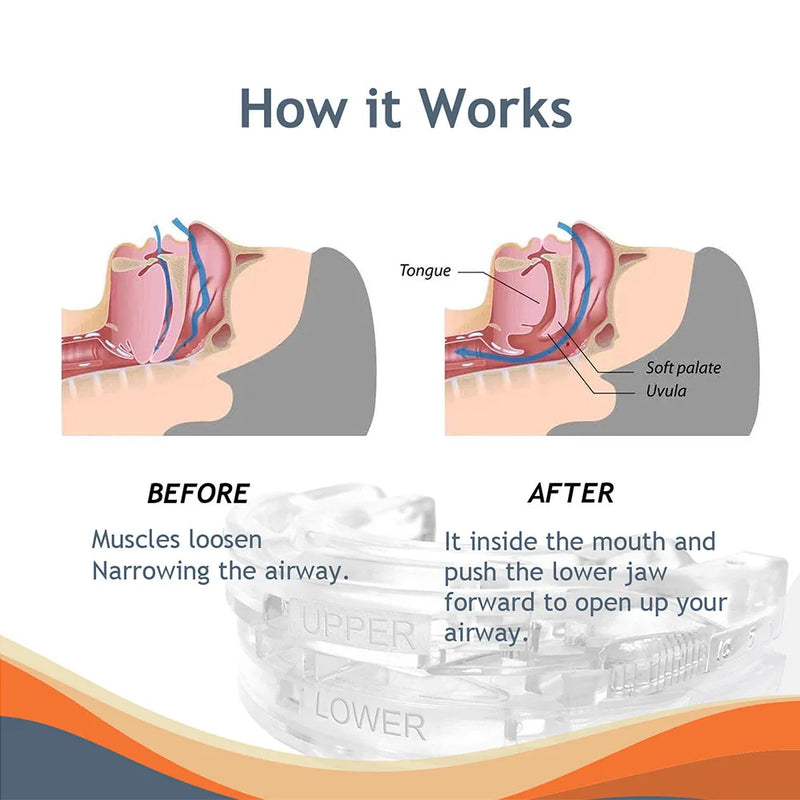 Protetor Bucal Anti-Ronco